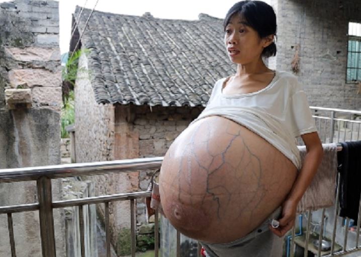A Chinese Woman Has A Very Large Belly Due To An Unknown Disease