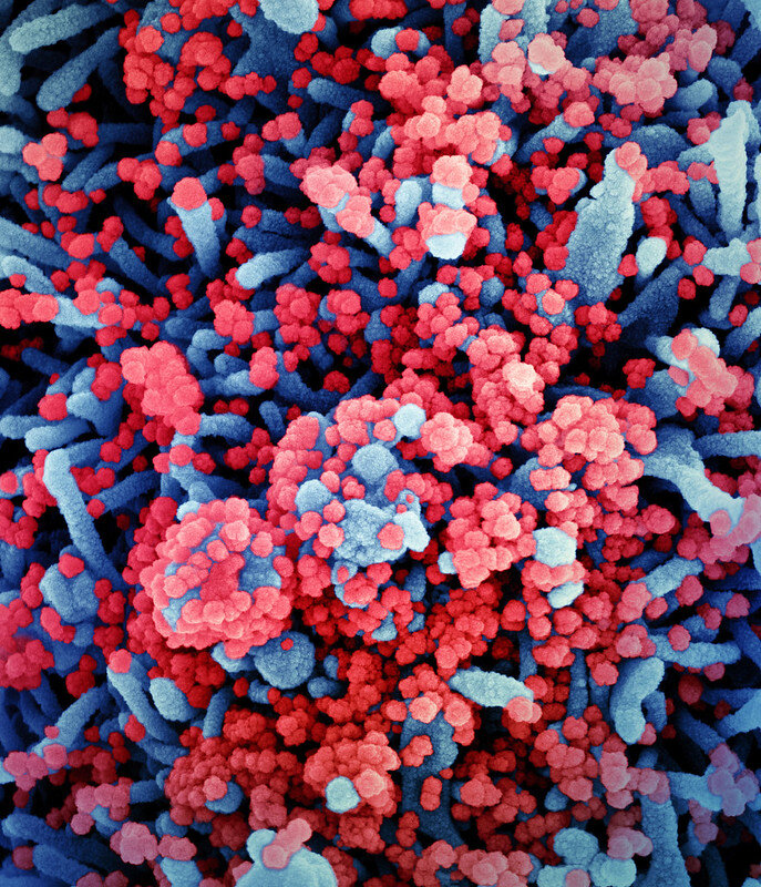 Colorized scanning electron micrograph of a cell (blue) heavily infect
