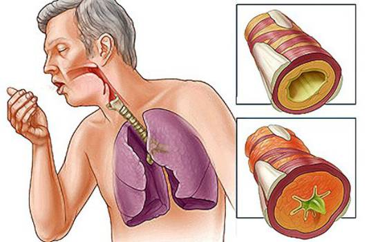 Kaip pašalinti gleives iš plaučių