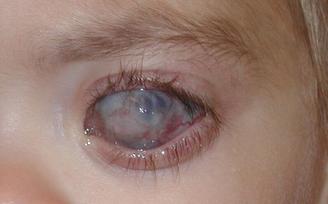 glaukoma, akių ligos, akys, ligos, medicine, health