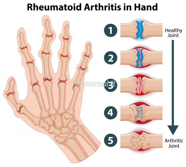 reumatoidinis artritas, artritas, antikūniai, skausmas, sąnariai
