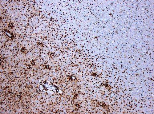 Study explains the process that exacerbates multiple sclerosis
