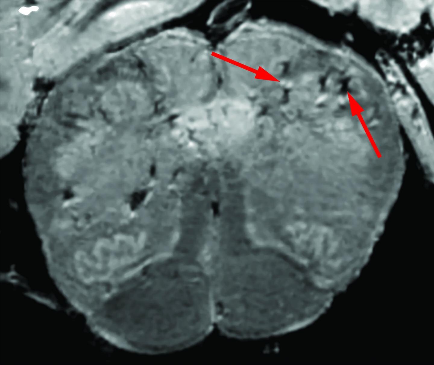 Brain damage of patients with Covid-19