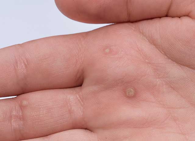 Warts: Causes and 10 natural remedies