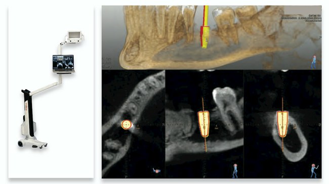 Odontologija, Dantys, Dantų gydymas, technologijos, dantų implantacija