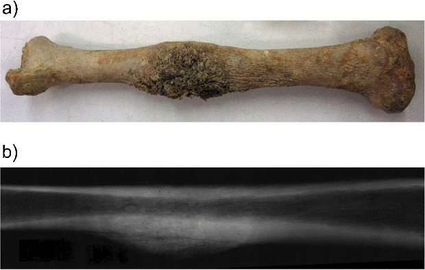 Dešiniojo blauzdikaulio nuotrauka ir rentgenograma su osteosarkomos su