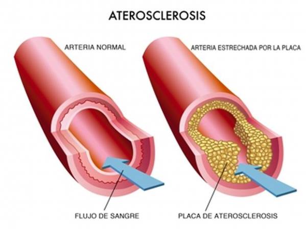 Arteriosklerozės modelis su skerspjūvine arterija