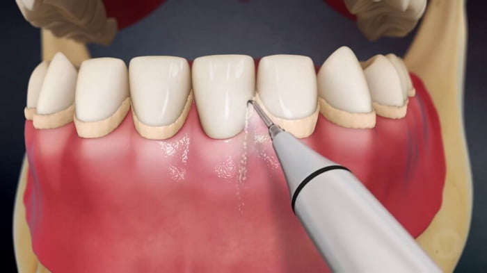 Kaip pašalinti dantų apnašas?