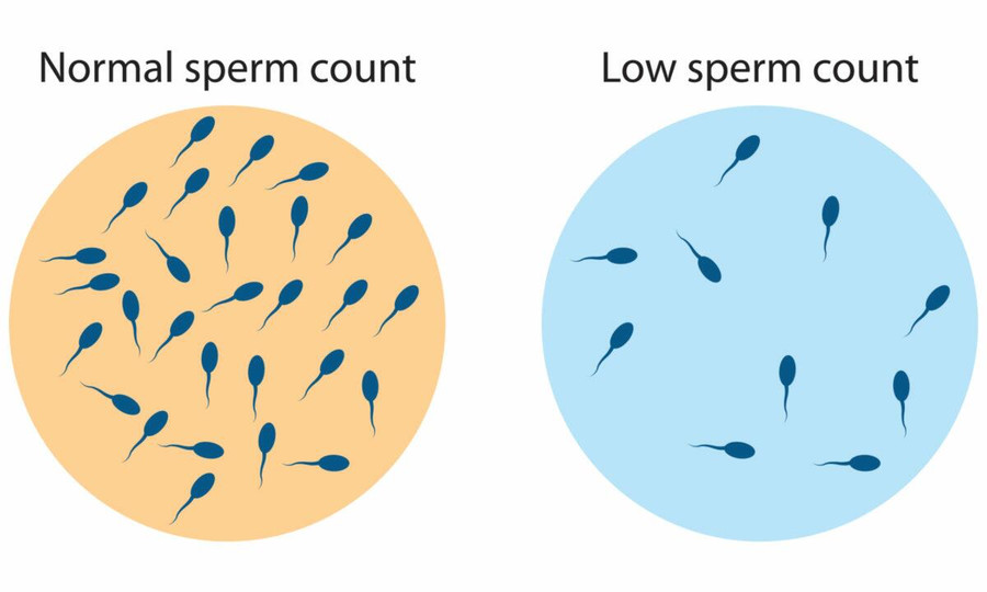 COVID-19 susijęs su ilgalaikiu spermos kokybės blogėjimu: Tyrimas
