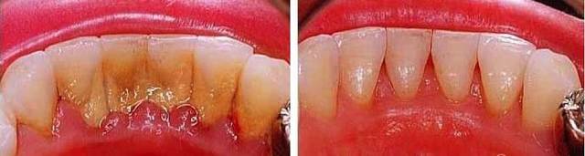Kaip atsikratyti akmenų nuo dantų be odontologo