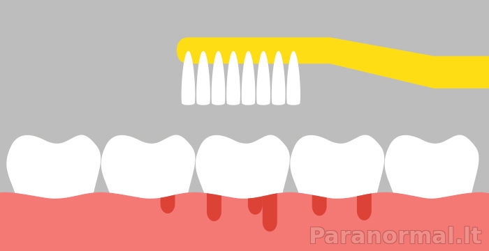 Kraujavimas iš dantenų: kokia priežastis ir kaip greitai sau padėti