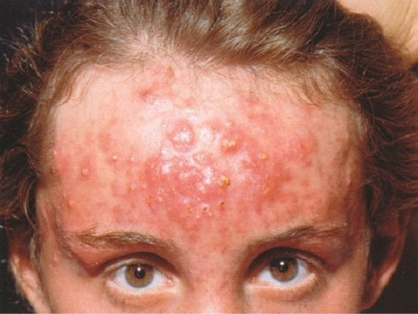 acne (spuogai)