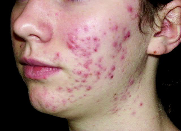acne (spuogai)