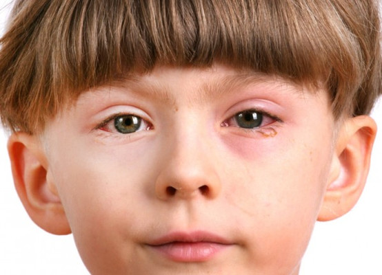 Akių alergijos priežastys ir gydymas