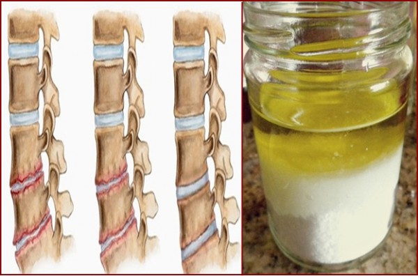 Druska ir aliejus: gydomasis mišinys - po jo naudojimo, jūs nebejausite skausmo kelis metus