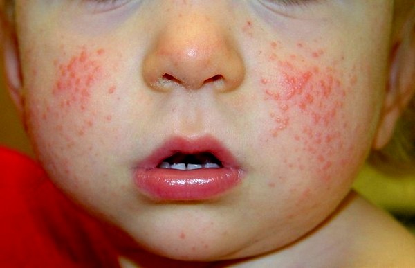 alergija, skiepai, skiepijimas, vakcinacija, vakcinos, žemes riešutai