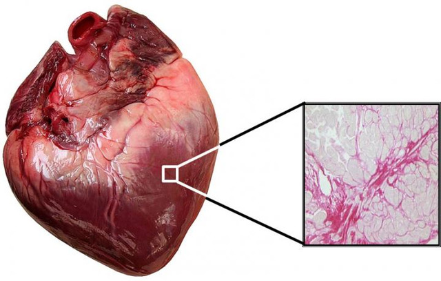 širdies ląstelės, infarktas, širdies ligos, nekroze, miofibrilės