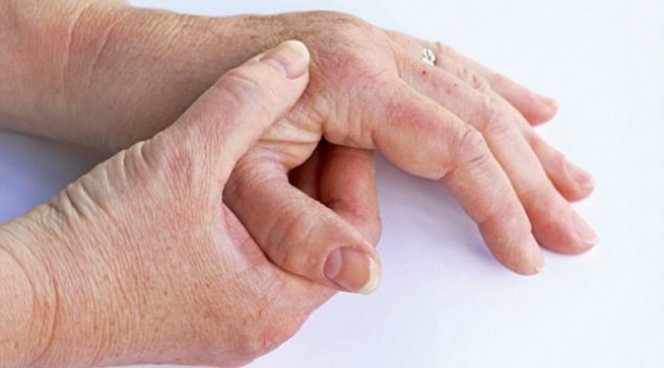 Reumatoidinis artritas, Sąnariai, Autoimuninės ligos, ligos, medicina