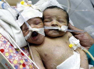 Jemenas, dvigalvis berniukas, dvi galvos, gimė