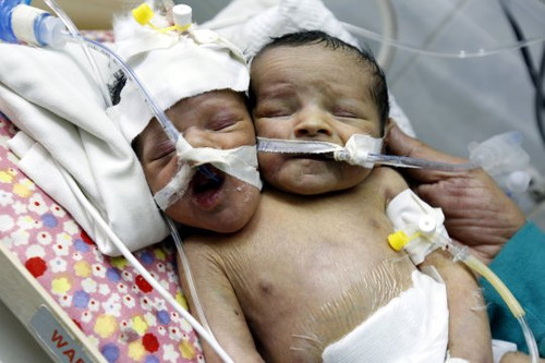 Jemene gimė dvigalvis berniukas