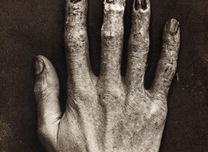 Pažeista rentgeno aparato techniko ranka